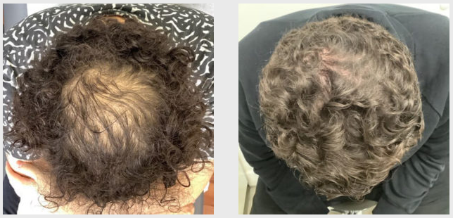 Happy Head | Customized Topical Finasteride for Hair Loss