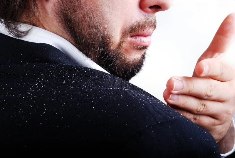 Man with dandruff on shoulder